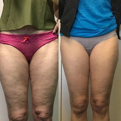 Celure Anti-Cellulite Massage