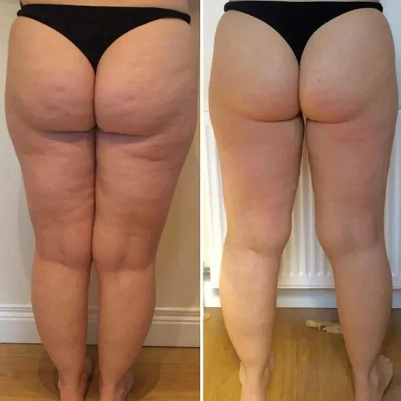 Celure Anti-Celluliter Massage