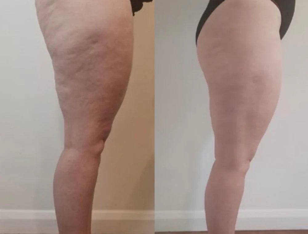 Celure Anti-Celluliter Massage
