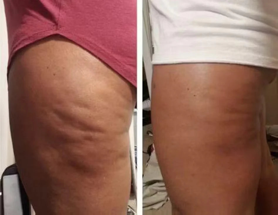 Celure Anti-Celluliter Massage